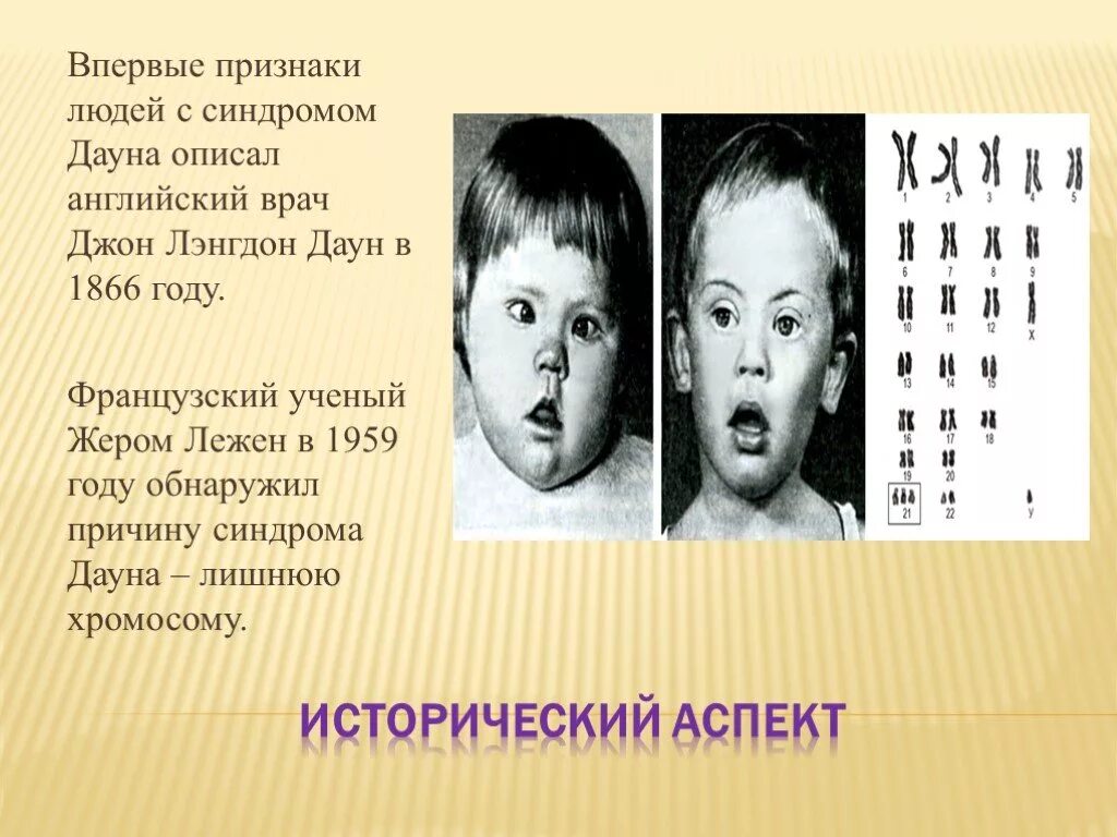 Сколько хромосом у людей с синдромом дауна. Синдром Дауна внешние проявления. Симптоматика синдрома Дауна. Болезнь Дауна биология.