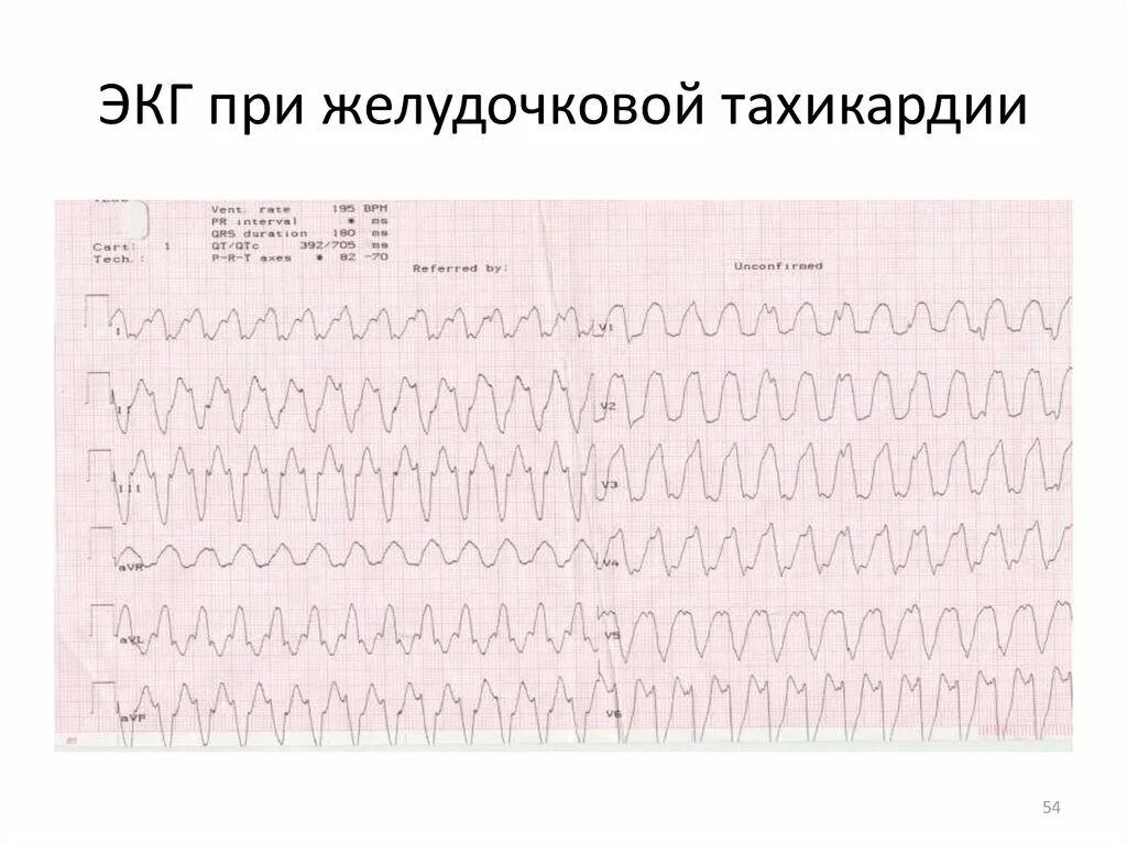 Желудочковая тахикардия на экг. Пробежка желудочковой тахикардии на ЭКГ. Номенклатура при желудочковой тахикардии. Протокол Виллсон желудочковая тахикардия. АВ диссоциация при желудочковой тахикардии.