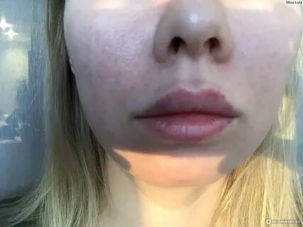 Дермалакс для увеличения губ
