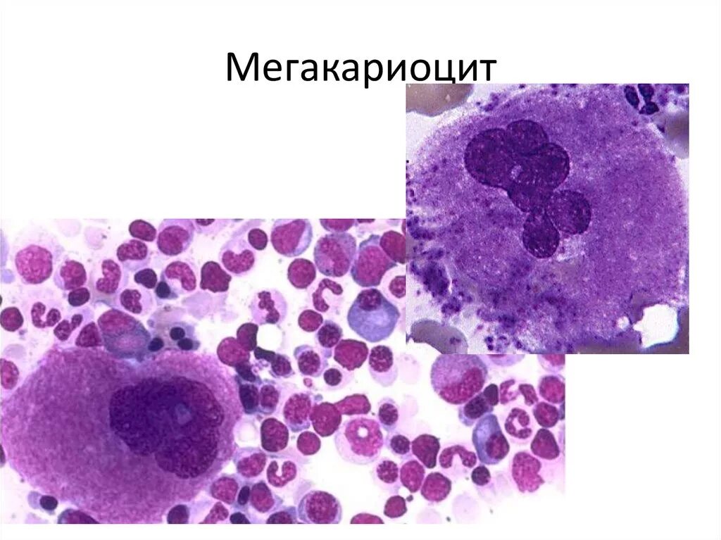 Мегакариоциты красного мозга. Мегакариоциты в костном мозге. Мегакариоцит оксифильный. Красный костный мозг гистология мегакариоцит. Промегакариоцит и мегакариоцит.