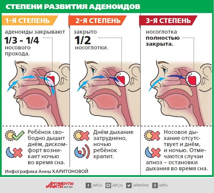 Как вылечить аденоиды у ребенка. Схема лечения аденоидов у детей 2 степени. схема лечения аденоидов у детей 1 степени. аденоиды 2 степени у ребенка 3 года.