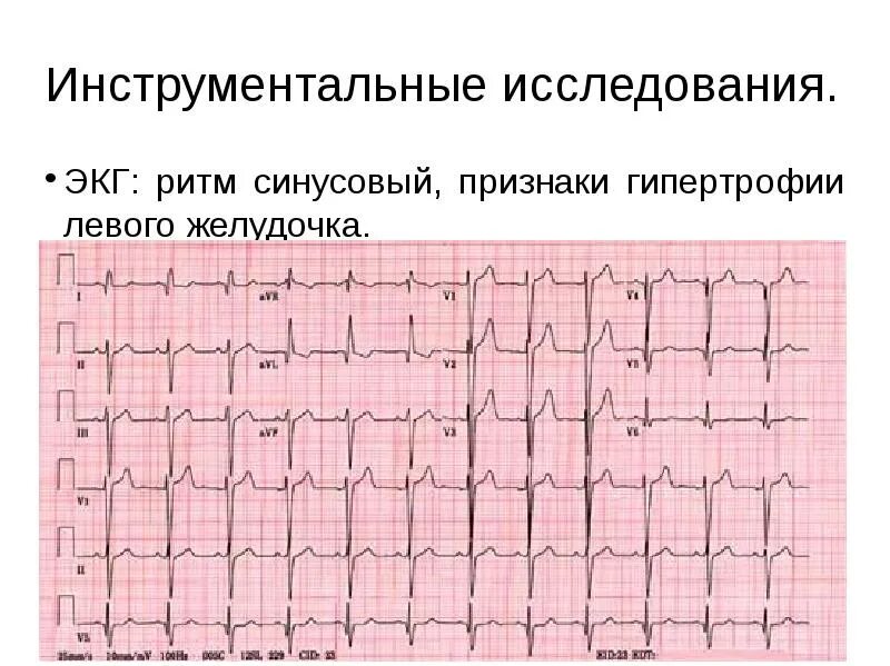 Экг при диффузных изменениях миокарда. Экг гипертрофия левого желудочка заключение. Синдром ранней реполяризации на экг. Диффузно дистрофические изменения в миокарде. Диффузные изменения желудочков.