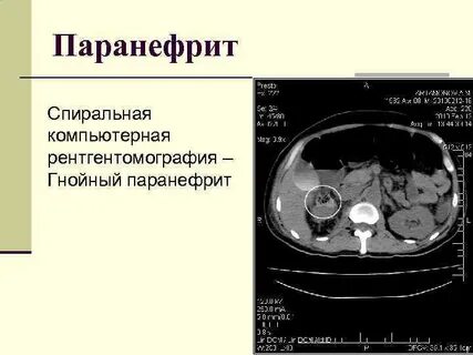 Паранефрит