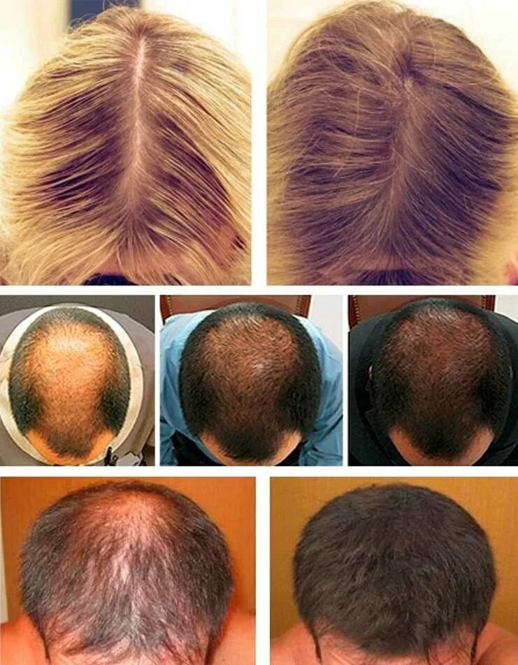 Мезо для волос отзывы. Мезотерапия волос до и после. hair мезотерапия для волос. мезотерапия волос головы. плазмолифтинг для волос.