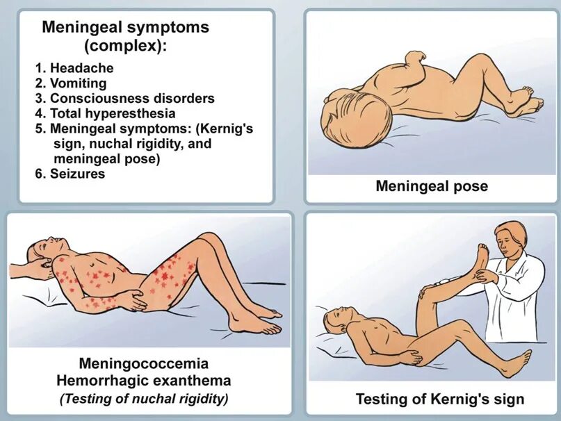 Симптомы менингита у человека. Менингеальные симптомы у детей 1 года. Минингитовая инфекция симптомы у детей 3 лет. 8 Месяцев ребенку менингеальные симптомы. Менингеальные симптомы у детей до 1 года.