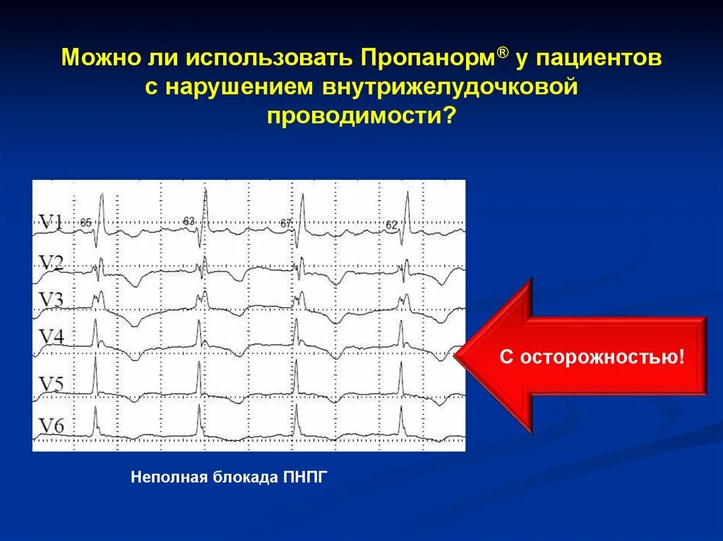 Мкб 10 блокада правой ножки пучка гиса. Нарушение проводимости по ПНПГ. Нарушение в/желудочковой проводимости по ПНПГ. Неполная блокада правой ножки Гиса. Неполная блокада правой ножки пучка Гиса.