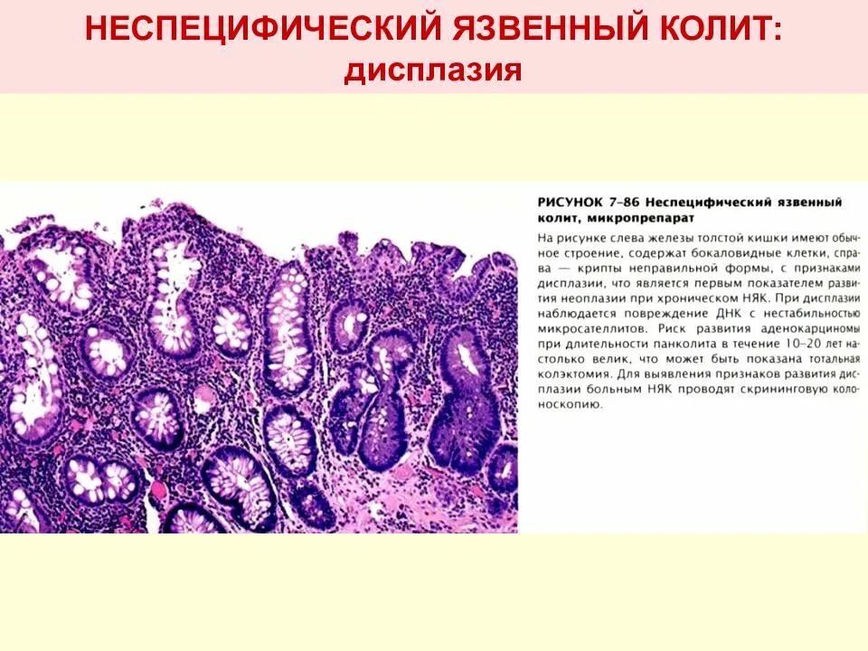 Причина язвенного колита у взрослых