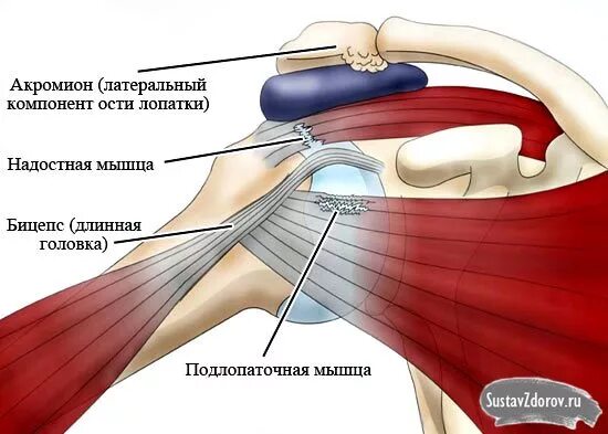 Надостный тендинит плечевого сустава. Тендовагинит сухожилия двуглавой мышцы. Тендиноз сухожилия плечевого сустава. Теносиновит плечевого сустава.