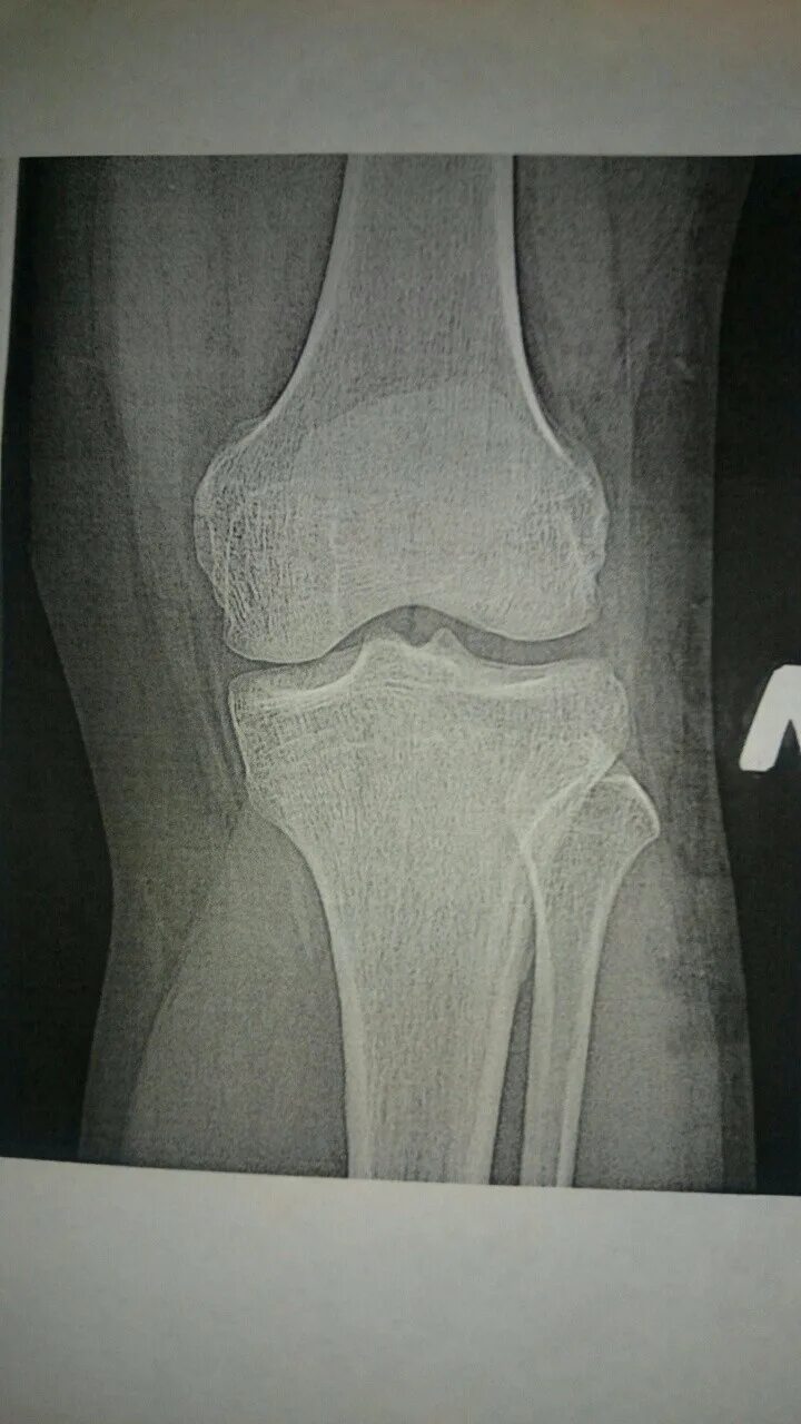 Колени хрустят и болят при приседании. Рентген коленного сустава. Хрустящий сустав рентген.