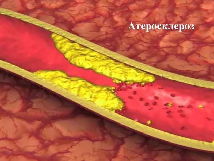 Атеросклероз гемодинамически незначимый. Атеросклероз гемодинамически незначимый. Поражение сосудов атеросклерозом. Атеросклероз гемодинамически незначимый. Атеросклероз гемодинамически незначимый.