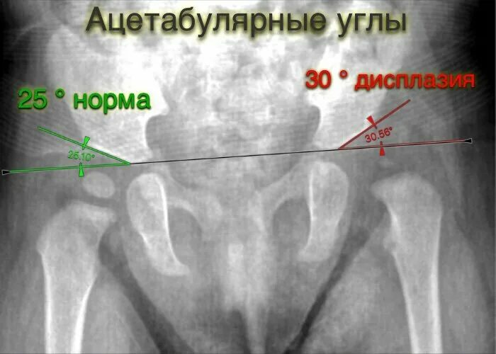 Дисплазия тазобедренного сустава мкб 10. Ацетабулярный угол рентген норма. дисплазия тазобедренных суставов анатомия. ацетабулярная тазобедренная дисплазия. ацетабулярный угол таблица.