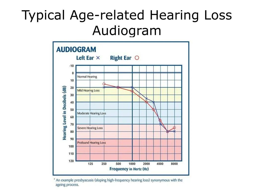 Yamaha Audiogram 6. Audiogram normal. Hearing loss statistics. Severe hearing loss Table.