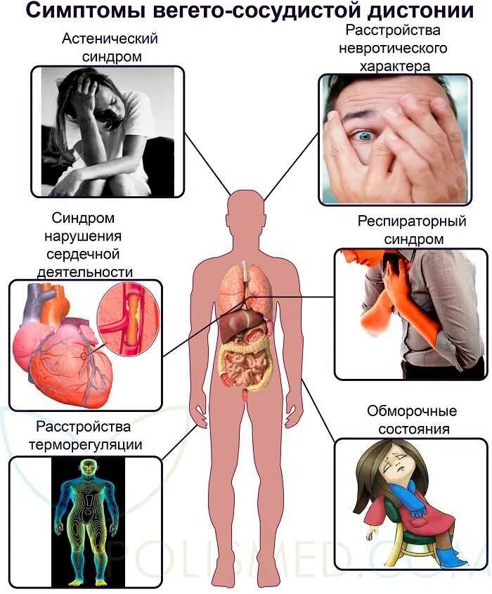 См всд. Вегетососудистая дистония симптомы. Вегетативно сосудистая дистония симптомы. Вегасосудочная дистония симптомы. Сосудистодисания симптомы.