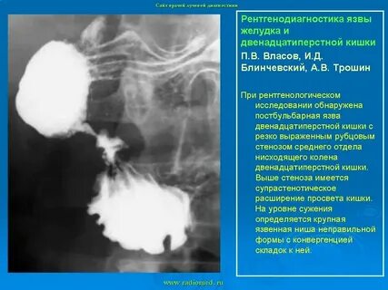 Деформация луковицы дпк