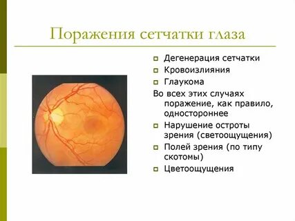 Болит сетчатка глаза