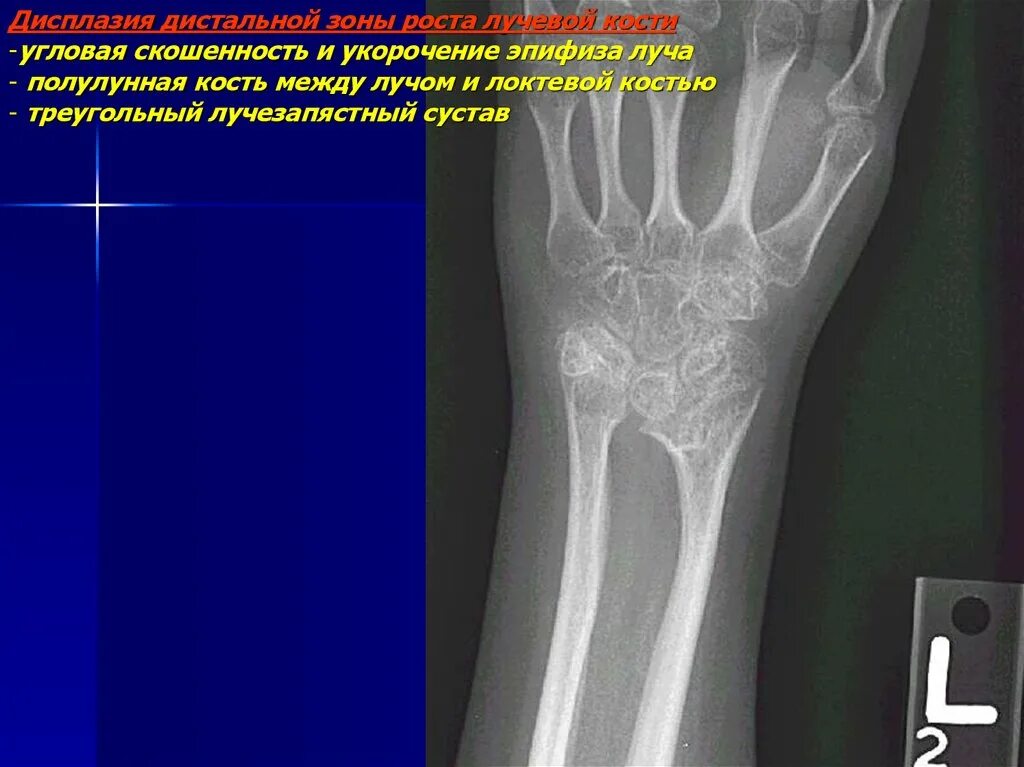 Зона роста лучевой кости. Зоны роста лучевой кости у детей. Дисплазия лучевой кости. Зона роста лучевой кости рентген схема.