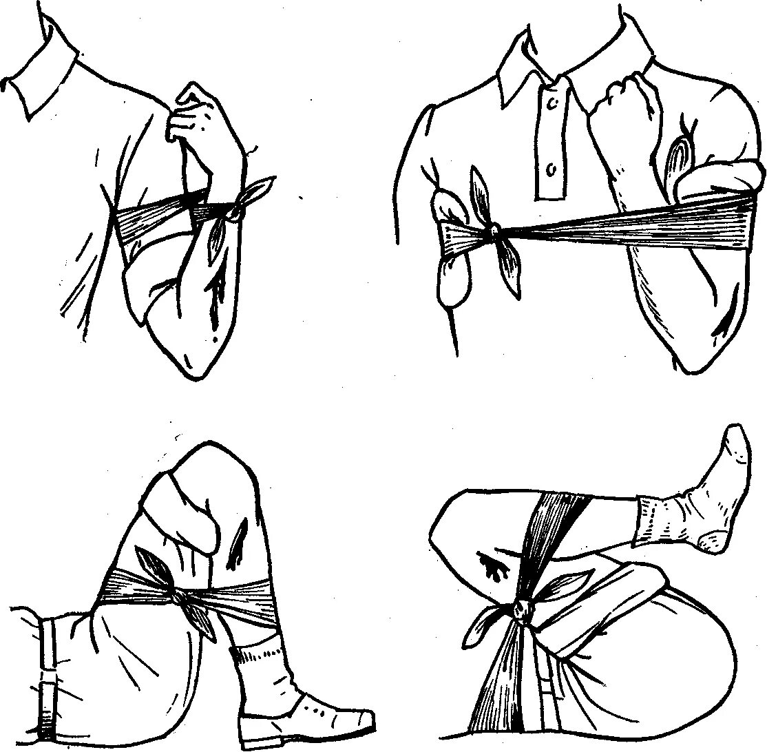 Способы наложения повязок при кровотечении. Предельное сгибание конечности в суставе. Перевязка для остановки кровотечения. Фиксированное сгибание конечности. Накладывание жгута на руку.