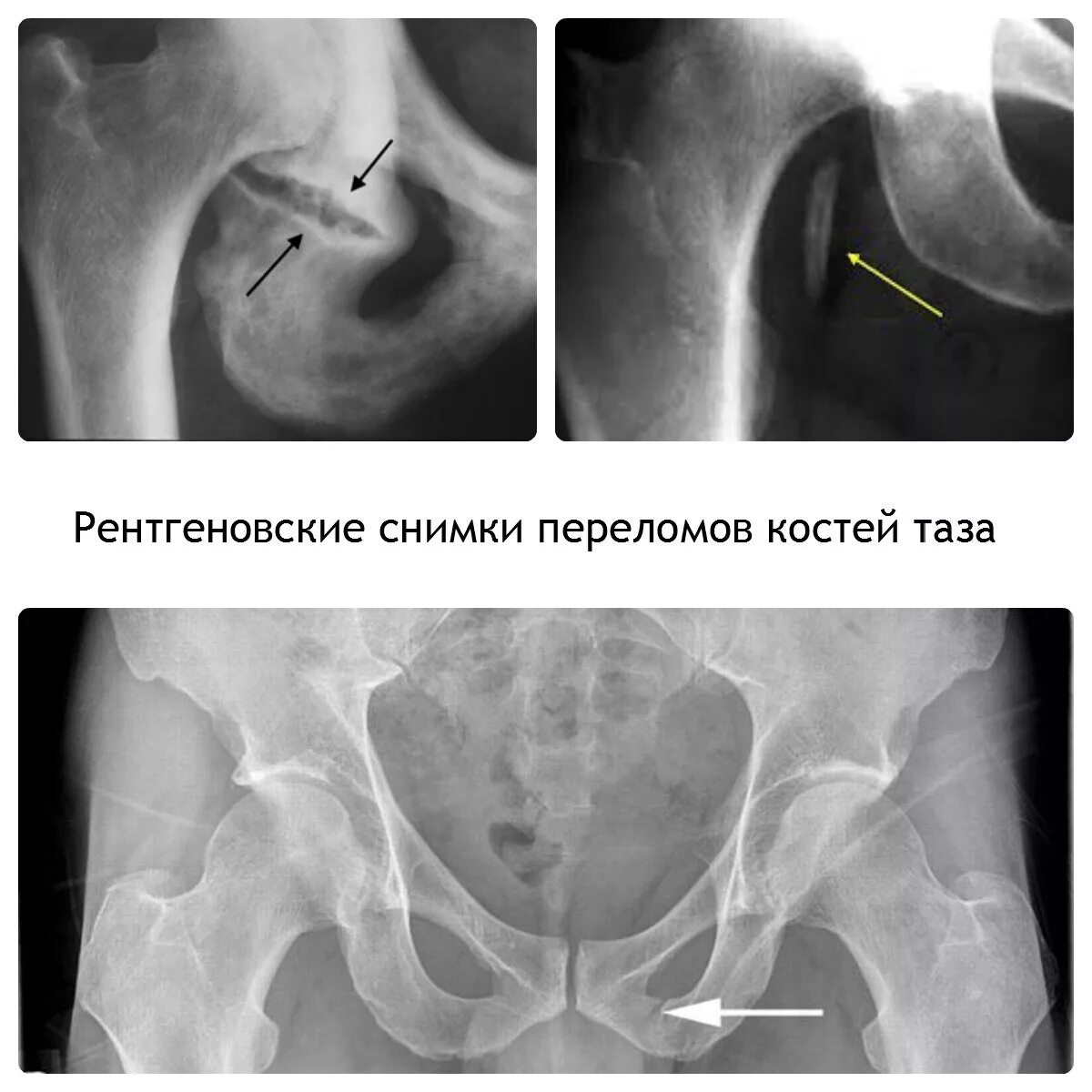 Перелом лонной и седалищной кости. Стабильные переломы костей таза.