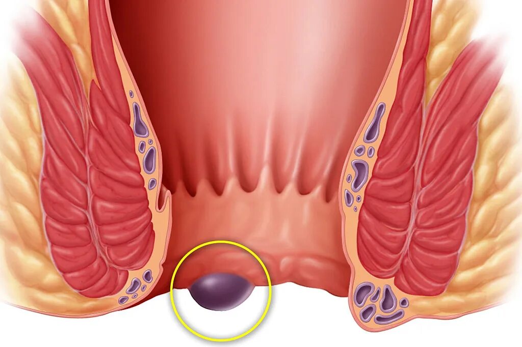 Геморрой причина появления у мужчин лечение. Геморроидальные бахромки. Геморройный узел наружный.