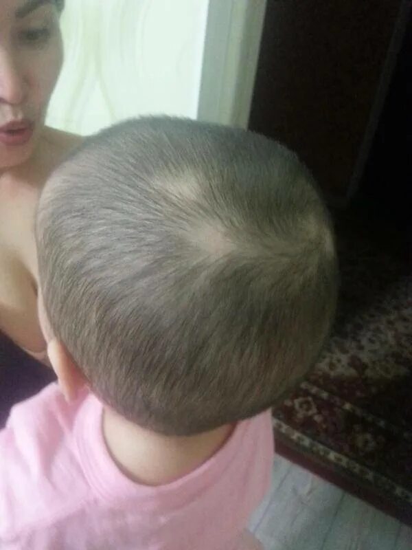 Почему плохо растут волосы на голове. Лысина на затылке у ребенка 2 года. Лысина на голове у ребенка 1 год. Гнёздная алопеция у детей. Отрастить волосы на затылке.