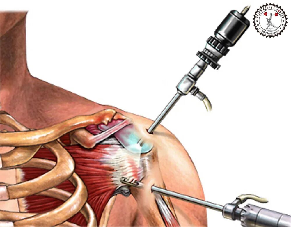 Артроскопическая операция плечевого сустава. Артроскопическая субакромиальная декомпрессия плечевого сустава. Артроскопическая санация плечевого сустава. Артроскопия плечевого сустава операция. После операции болят плечи