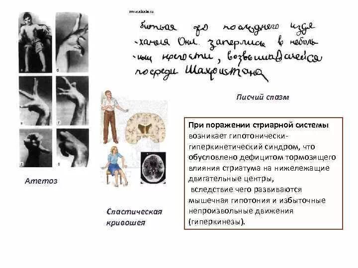 Писчий спазм. Как определить писчий спазм дома.