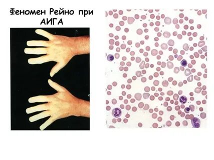 Феномен т