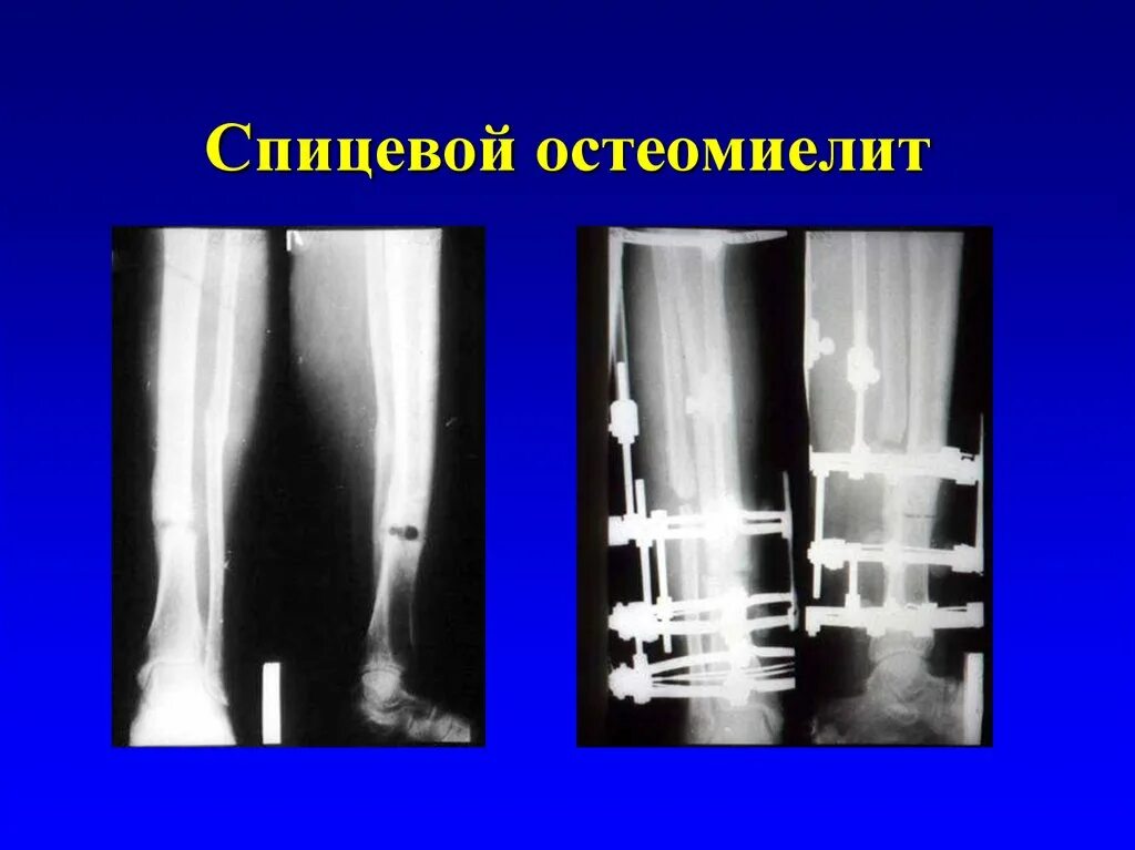 Оперативное лечение остеомиелита. Альбуминозный остеомиелит. Остеомиелит коленного сустава рентген. Местная форма гематогенного остеомиелита. Остеомиелит 1 плюсневой кости.