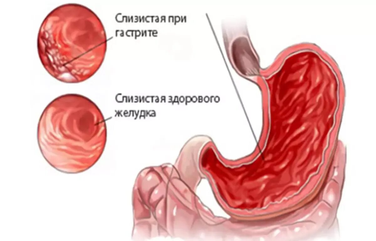 Гастрит клин. Поверхностный катаральный гастрит. Слизистая желудка гиперемирована. Эрозированный гастрит. Поверхностный антральный гастрит.