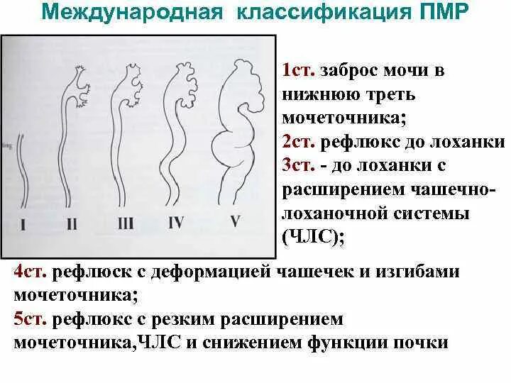 Рефлюкс у ребенка форум. Пузырно-мочеточниковый рефлюкс классификация. пузырно-мочеточниково-лоханочный рефлюкс (пмр). степени пузырно-мочеточникового рефлюкса рентген. пузырно-мочеточниковый рефлюкс на кт.