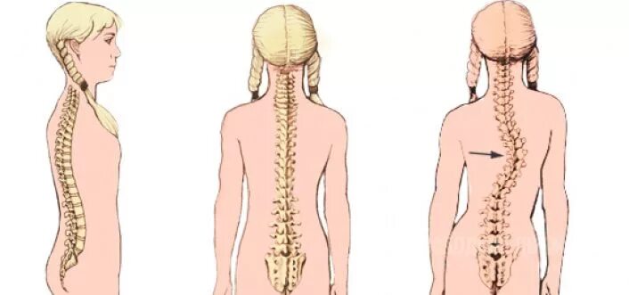 Сколиотическая осанка. Сколиотическая деформация грудного отдела позвоночника. Сколиоз 1 степени поясничного отдела. 1 Стадия сколиоз поясничного отдела.