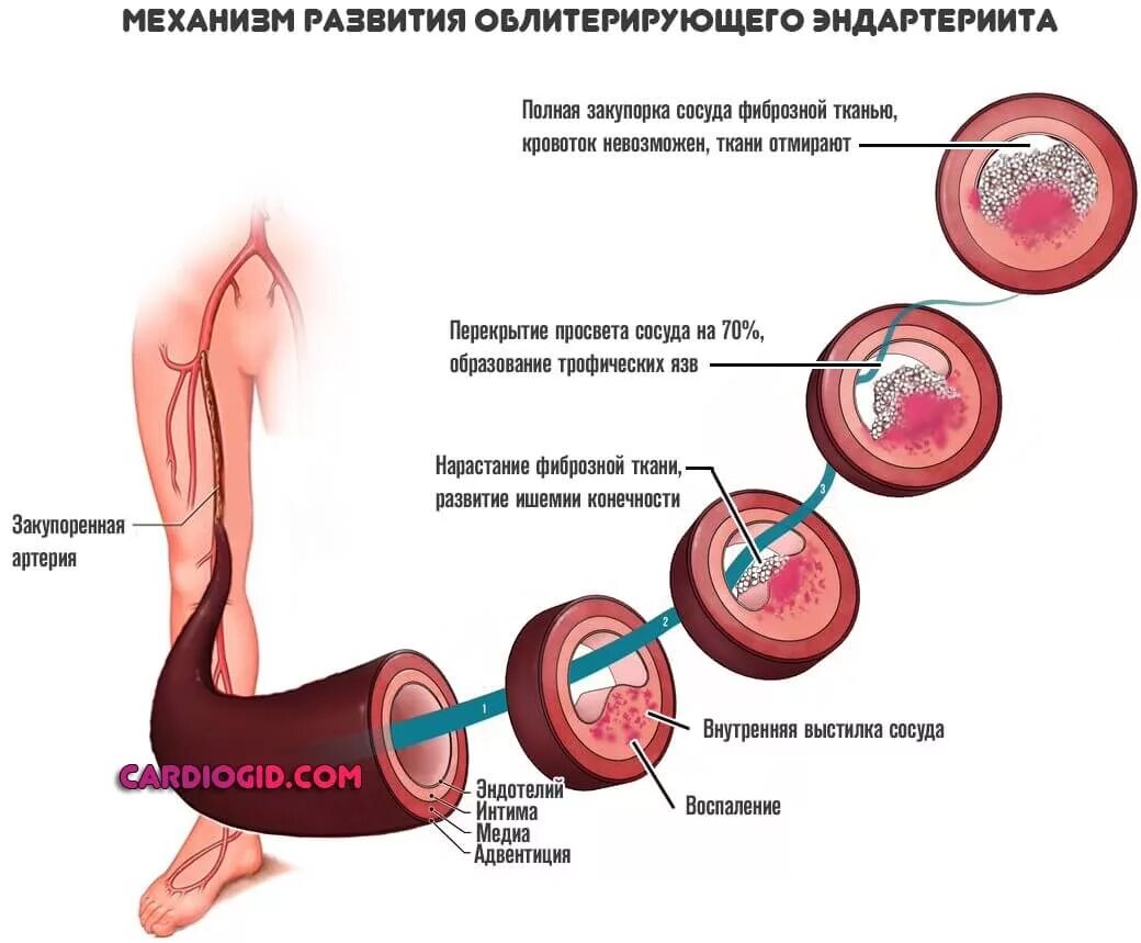 Облитирующий атеросклероз. Эндартериит патогенез. облитерирующий эндартериит патогенез. облитерирующий эндартериит этиология патогенез. болезни артерий облитерирующий атеросклероз этиология.
