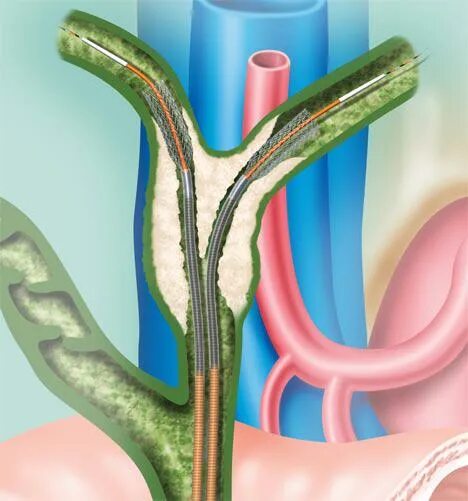 Стентирование холедоха желчного протока. Баллонной дилатации стентирование желчных протоков. ЭРХПГ стриктура холедоха. Эндоскопическое стентирование желчных протоков. Стент желчного протока