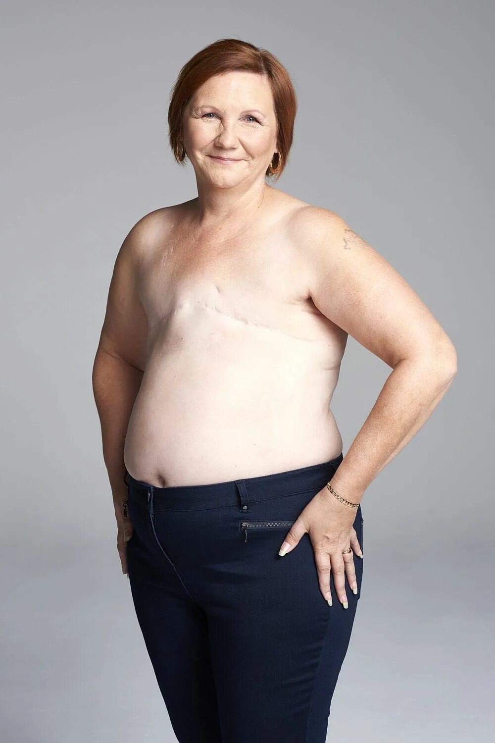 бандаж послеоперационный мастэктомии после мастэктомии. восстановить грудь. женщины с удаленной грудью. женщина после удаления молочной железы. женщина с одной грудью.