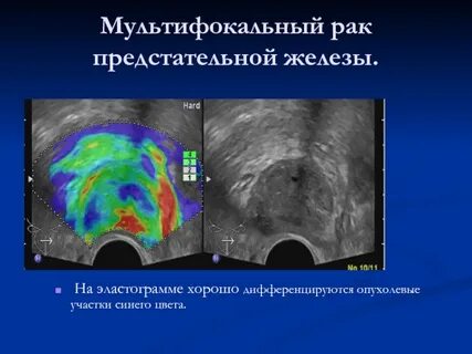 Отек простаты