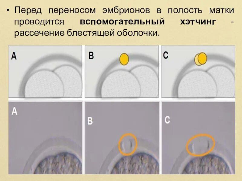 Подсаживали 2 эмбриона. Рассечение оболочки эмбриона вспомогательный хетчинг. Перенос эмбриона в матку. Эмбрион в матке после переноса. Вспомогательный хетчинг эмбриона рассечения блестящий оболочки.