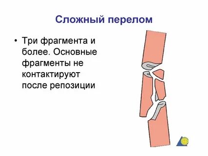 Перелом при котором линия перелома начинается