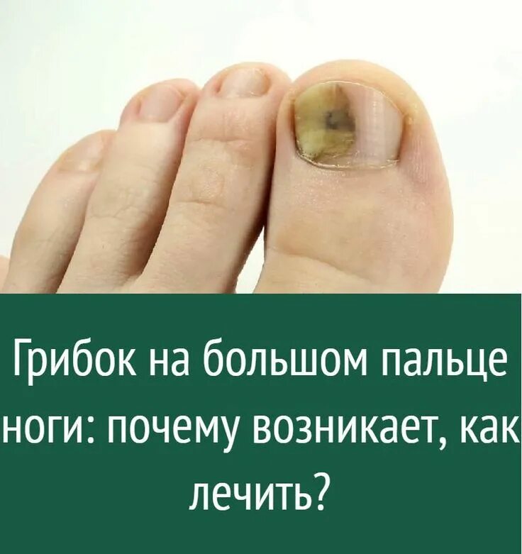 Грибок на ногте большого пальца ноги фото Виктор Андронов Красота, Педикюр, Маникюр, Киров на Яндекс Услуги