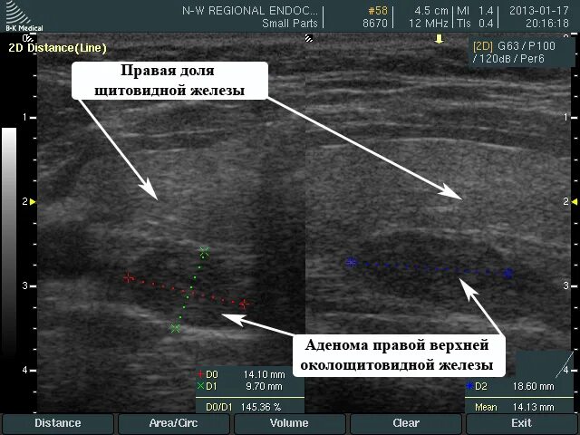 Аденома паращитовидной железы на УЗИ. Паращитовидная железа на УЗИ щитовидной железы. Паращитовидные железы на УЗИ норма. Паращитовидные железы на УЗИ протокол. Удаление правой доли щитовидной