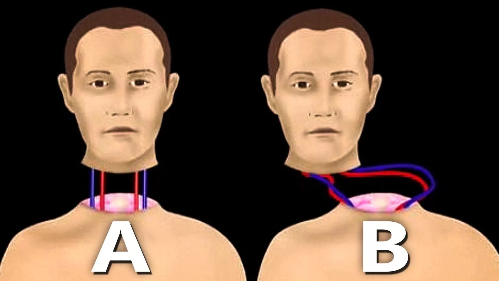 Пришивание человеческой головы. Пересадка человеческой головы. Пересадка головы закончилась