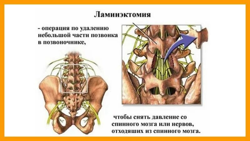 Ламинэктомия позвоночника этапы операции. Ламинэктомия поясничного отдела позвоночника. Декомпрессивная ламинэктомия позвонков l4-l5. Операция ламинэктомия на позвоночнике. Операция на позвоночнике отзывы пациентов