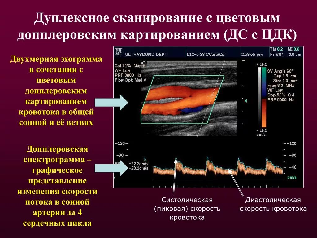 Доплер конечностей. Дуплексное и триплексное сканирование сосудов. Ультразвуковое допплеровское картирование сосудов шеи. Ультразвуковое цветовое дуплексное сканирование.