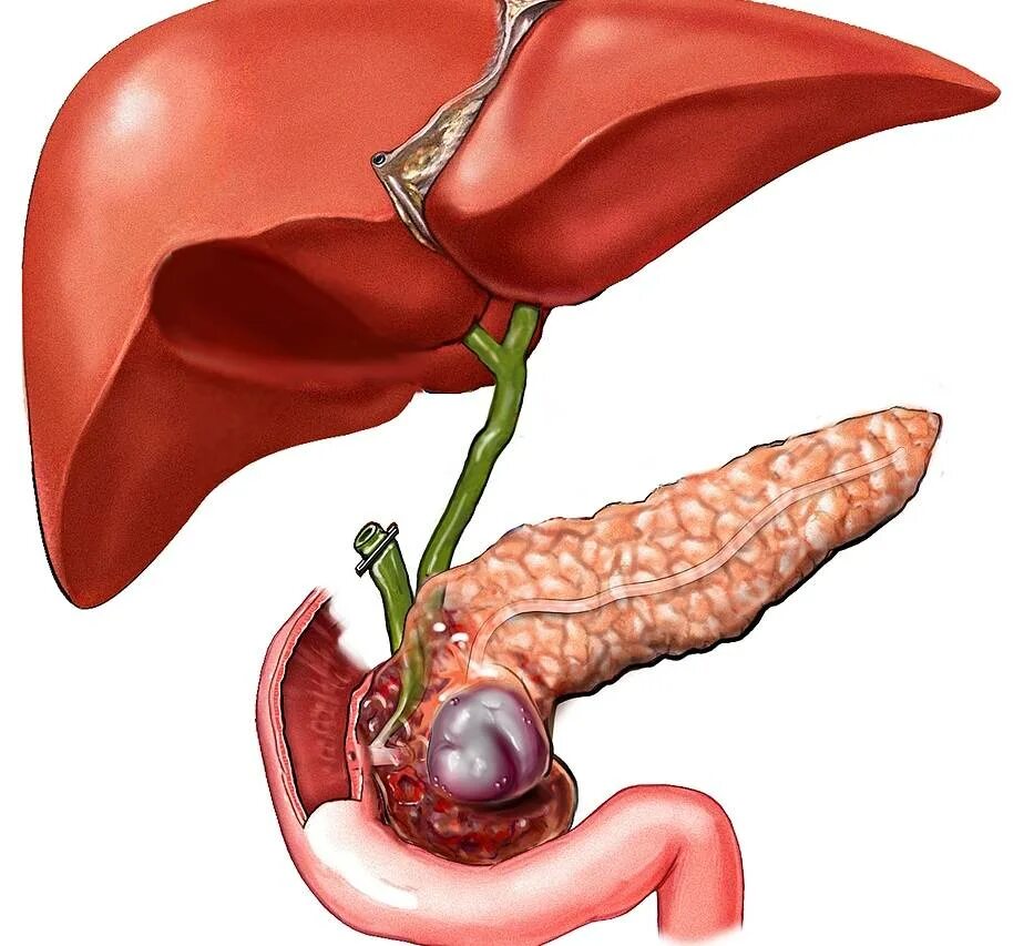 Панкреатит при удаленном желчном
