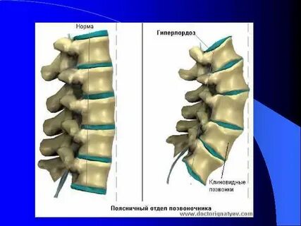 Клиновидная деформация позвоночника