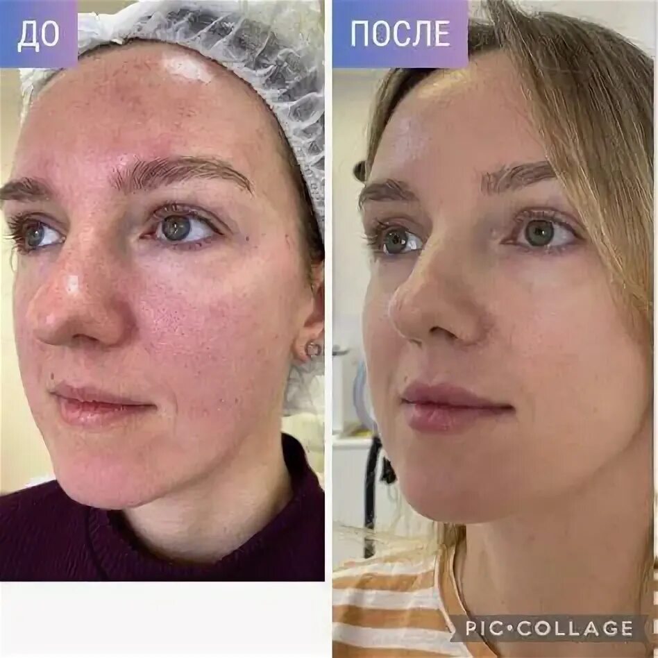 Aesthefill до и после отзывы фото Старинный японский метод омоложения и подтяжки лица всего за 5 дней! в 2022 г Ли