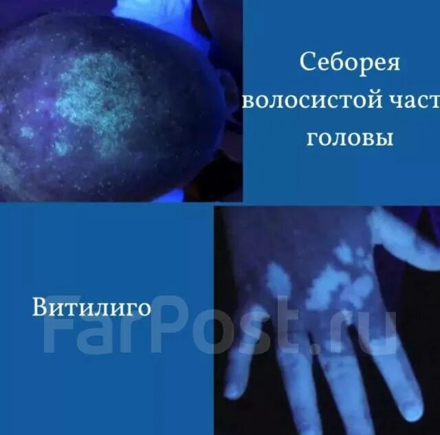 Лампа вуда витилиго. Витилиго под лампой вуда. Витилиго свечение под лампой вуда. Лампа вуда витилиго. Витилиго под лампой вуда.