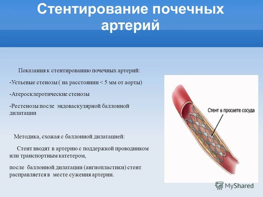 Ангиопластика почечных артерий. Ангиопластика почечных артерий. Стентирование почечной вены. Стентирование почечной артерии в екатеринбурге. Атеросклероз почечных артерий рентген.