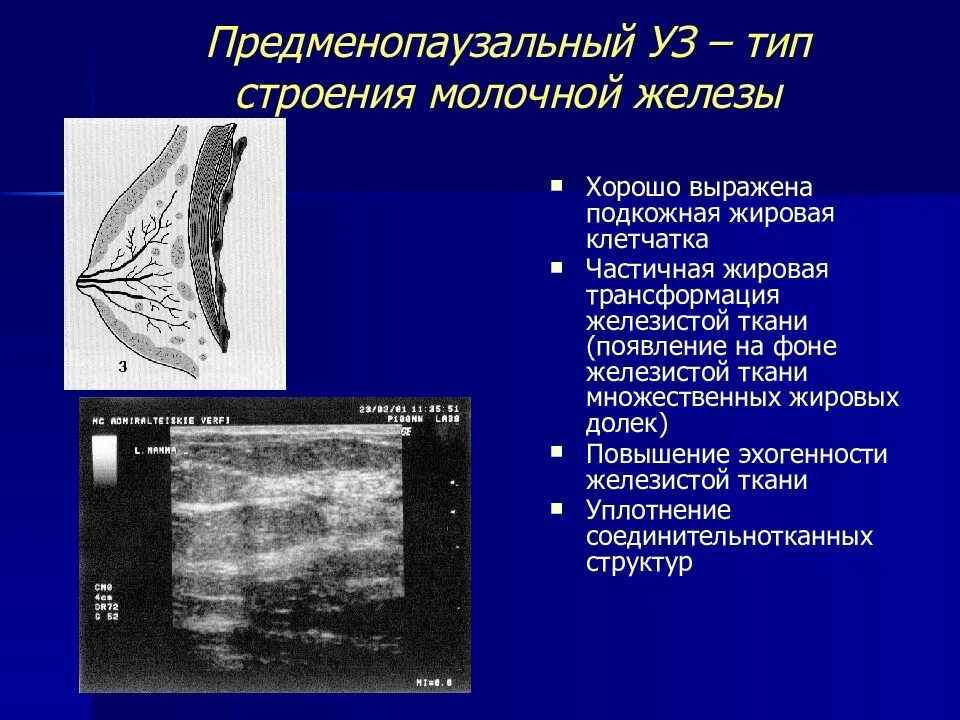 Ювенильный Тип строения молочных желез на УЗИ. Тип строения молочной железы по УЗИ. Строение железистой ткани молочной железы УЗИ. Строение молочной железы на УЗИ.