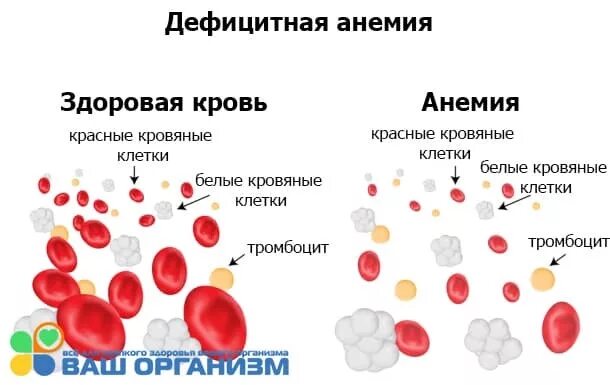 Гемоглобин при заболеваниях крови. Кровь здорового человека. Анемия иллюстрация.