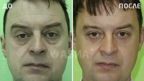 Таранов пластический